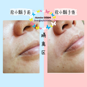 熱臘除毛~上唇~特價400元