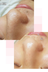 7月精選優惠活動~臉部保養❤️ 藻針淨痘優惠:5堂8500元