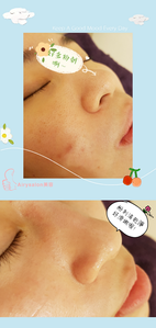 7月精選~臉部保養優惠方案~❤無痛粉刺(不含手工清痘)3堂 ~ 特價4800元
