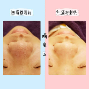 聖誕節優惠活動  臉部保養❤️A:無痛粉刺(不含手工清痘) 3 堂