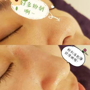 聖誕節優惠方案~臉部保養❤️粉刺淨痘 5 堂