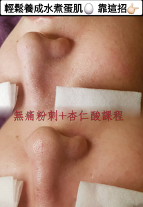 周年慶 ~ 臉部保養❤️: 杏仁酸:3堂2850元